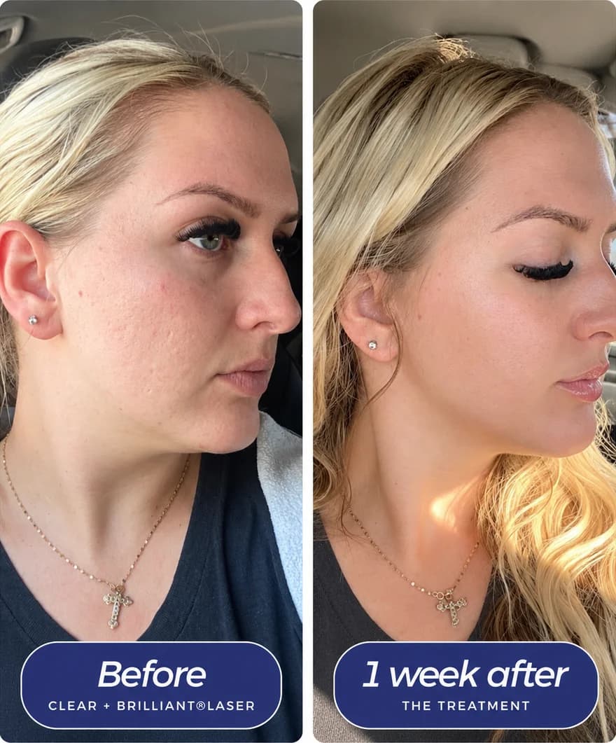 Before and one week after Clear + Brilliant Laser Facial